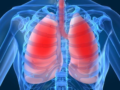 Thực hiện kế hoạch chăm sóc tăng cường 3 bước cho bệnh nhân viêm phổi cộng đồng