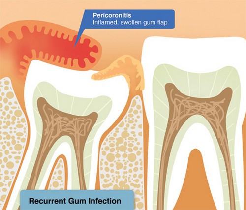 Cần điều trị sớm các bệnh nhiễm trùng nướu răng, lợi ở người nhiễm HIV
